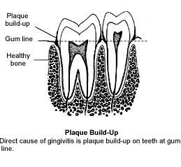 Gum Disease