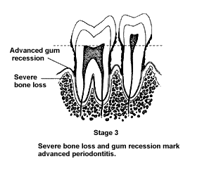 Gum Disease